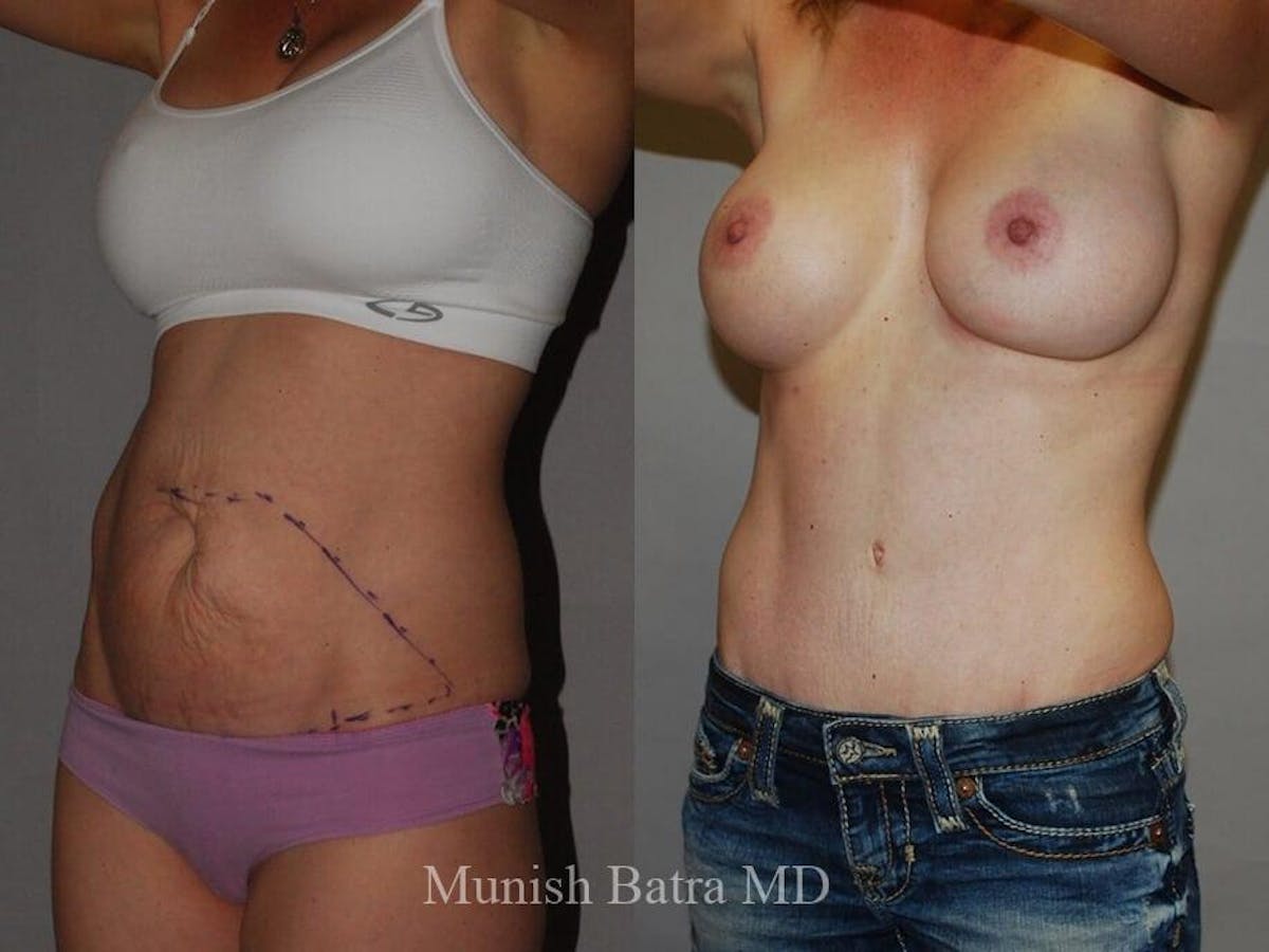 Tummy Tuck Before & After Gallery - Patient 121405 - Image 2