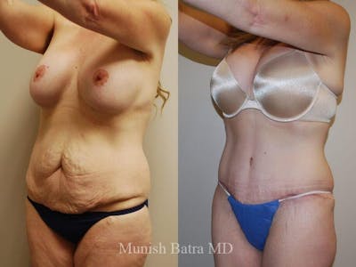 Tummy Tuck Before & After Gallery - Patient 351551 - Image 1