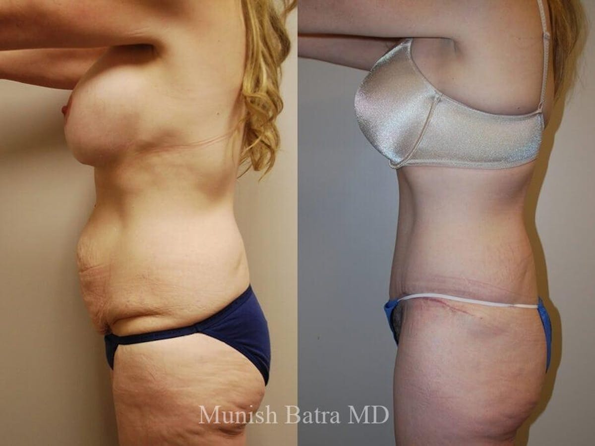 Tummy Tuck Before & After Gallery - Patient 351551 - Image 2