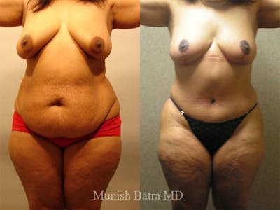 Tummy Tuck Before & After Gallery - Patient 179560 - Image 1