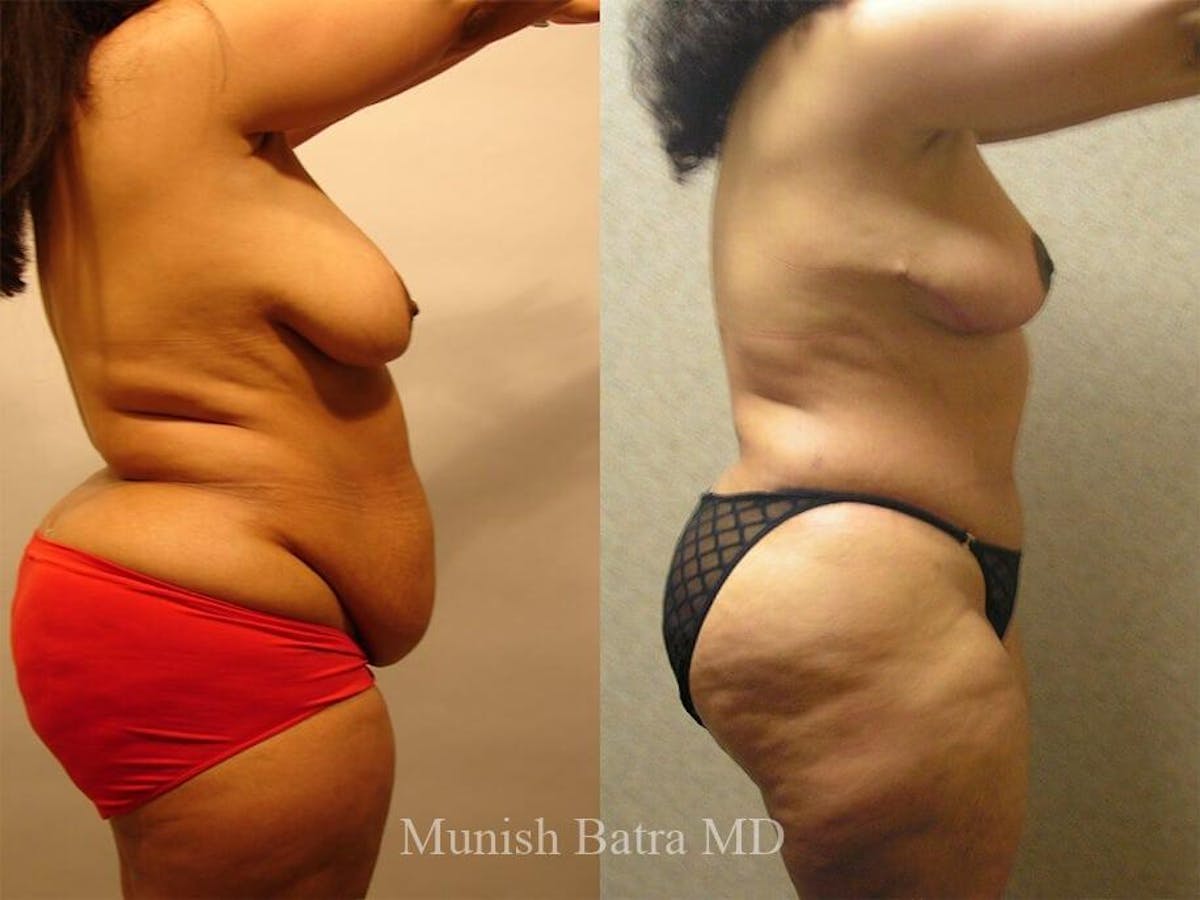 Tummy Tuck Before & After Gallery - Patient 179560 - Image 2