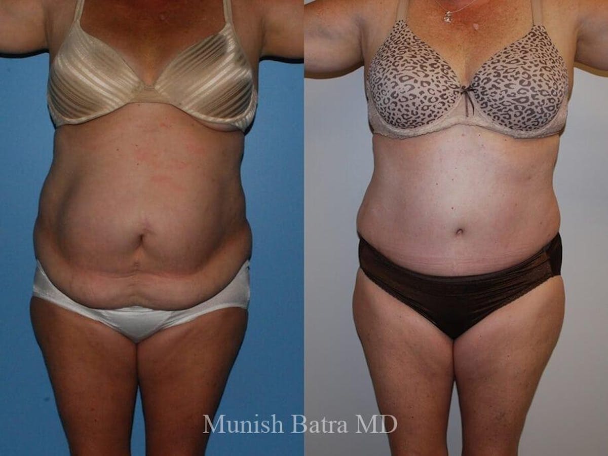 Tummy Tuck Before & After Gallery - Patient 164409 - Image 1