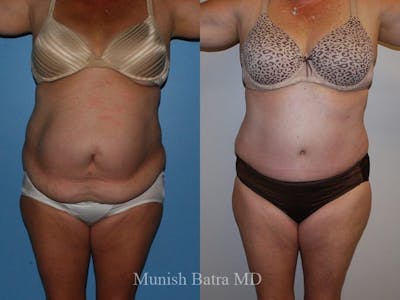 Tummy Tuck Before & After Gallery - Patient 164409 - Image 1