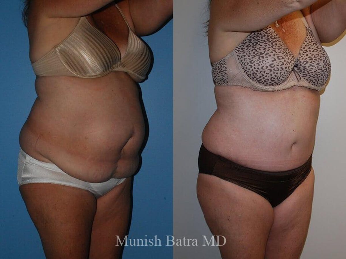 Tummy Tuck Before & After Gallery - Patient 164409 - Image 2