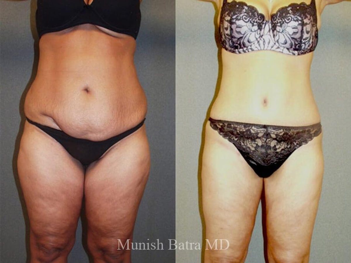 Tummy Tuck Before & After Gallery - Patient 115301 - Image 1