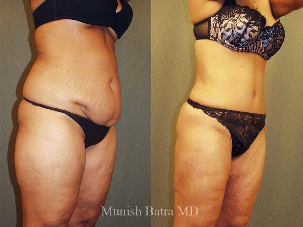Tummy Tuck Before & After Gallery - Patient 115301 - Image 2