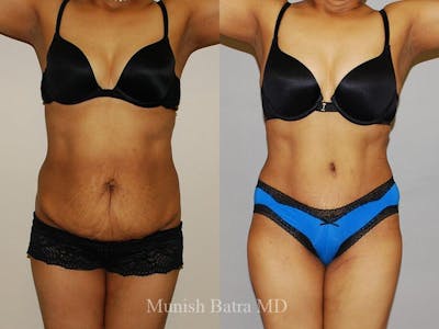 Tummy Tuck Before & After Gallery - Patient 395870 - Image 1