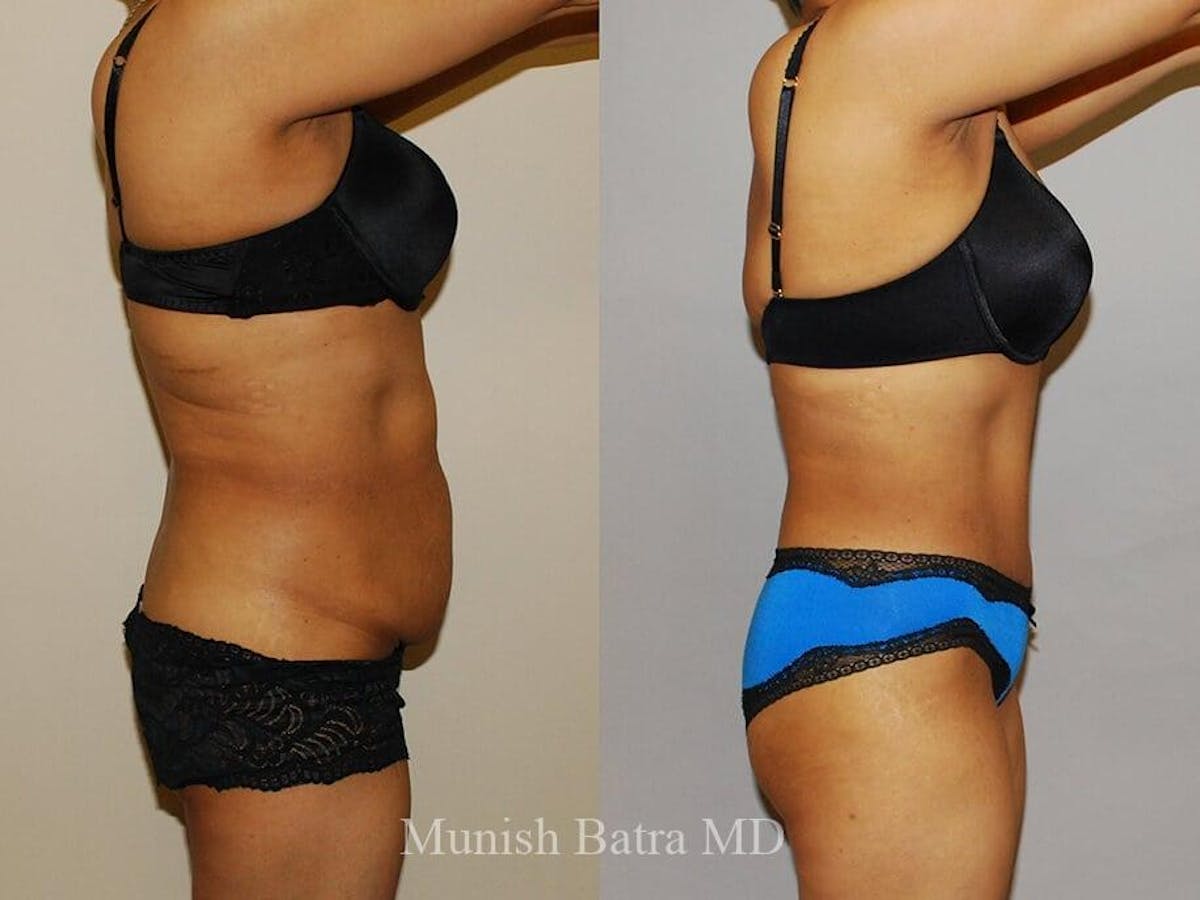 Tummy Tuck Before & After Gallery - Patient 395870 - Image 2