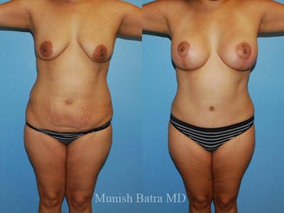 Tummy Tuck Before & After Gallery - Patient 396304 - Image 1