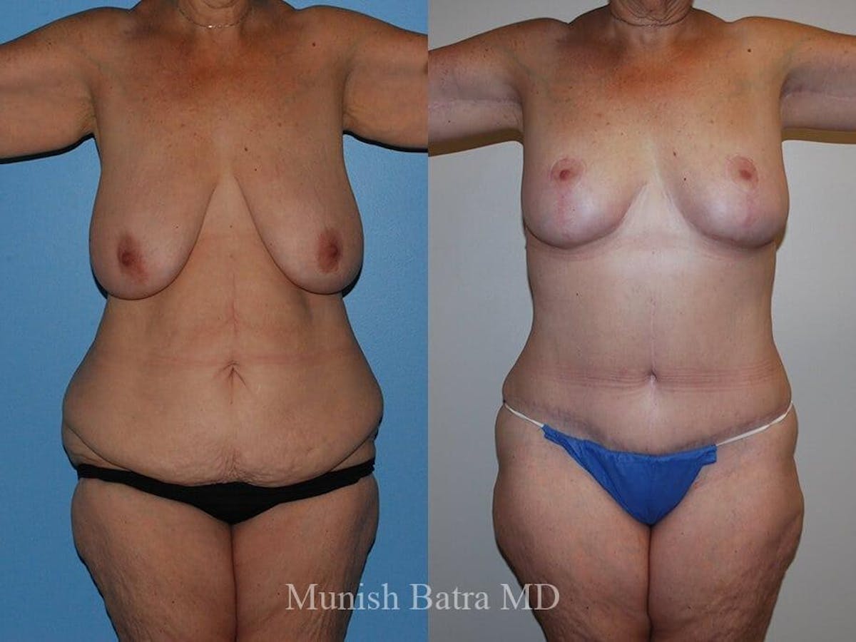 Tummy Tuck Before & After Gallery - Patient 218152 - Image 1