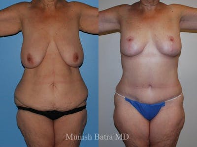 Tummy Tuck Before & After Gallery - Patient 218152 - Image 1