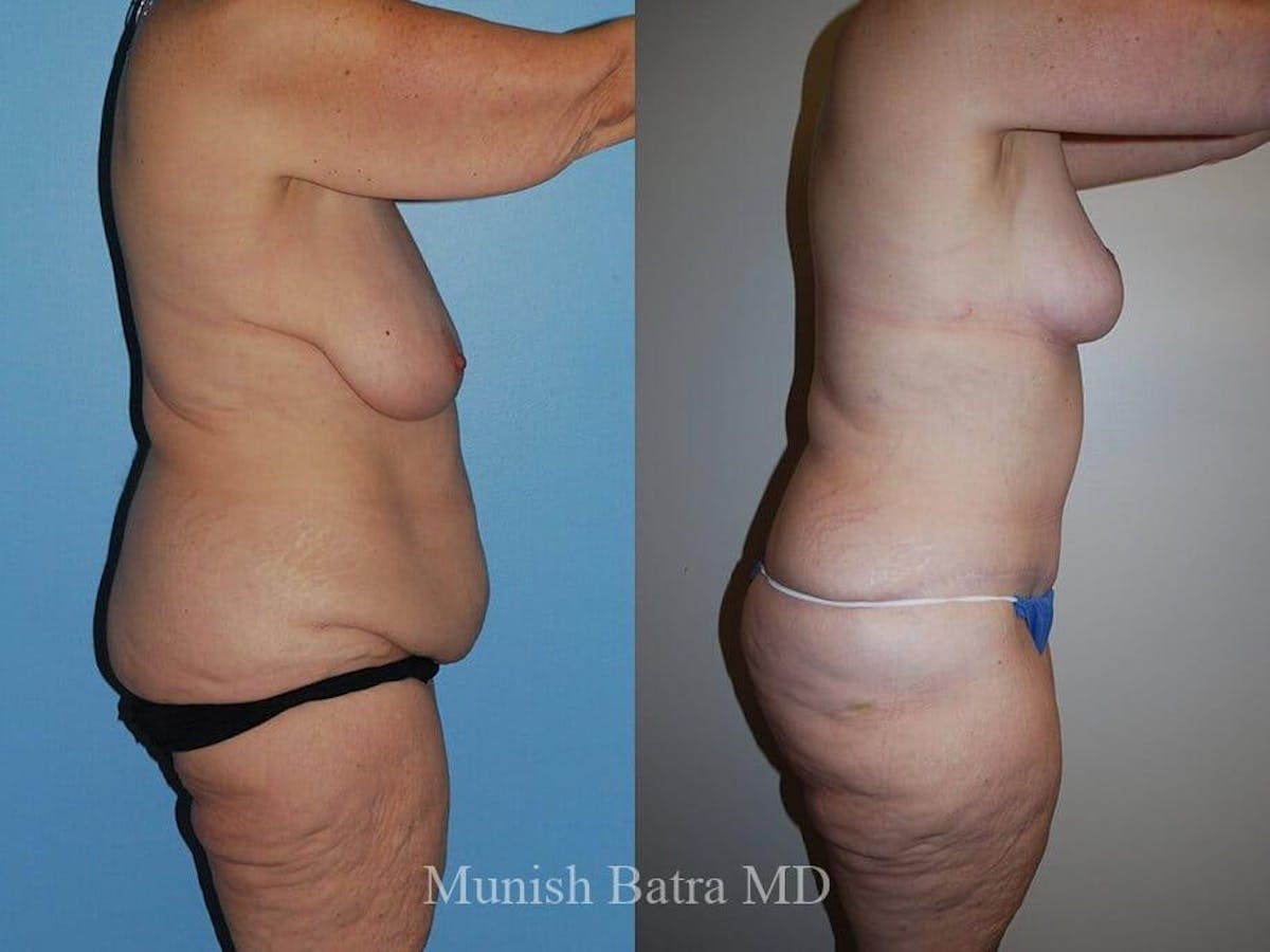 Tummy Tuck Before & After Gallery - Patient 218152 - Image 2