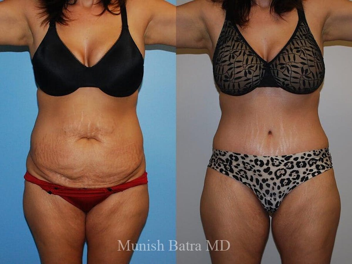 Tummy Tuck Before & After Gallery - Patient 242564 - Image 1