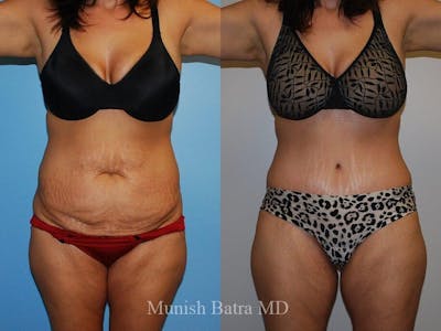 Tummy Tuck Before & After Gallery - Patient 242564 - Image 1