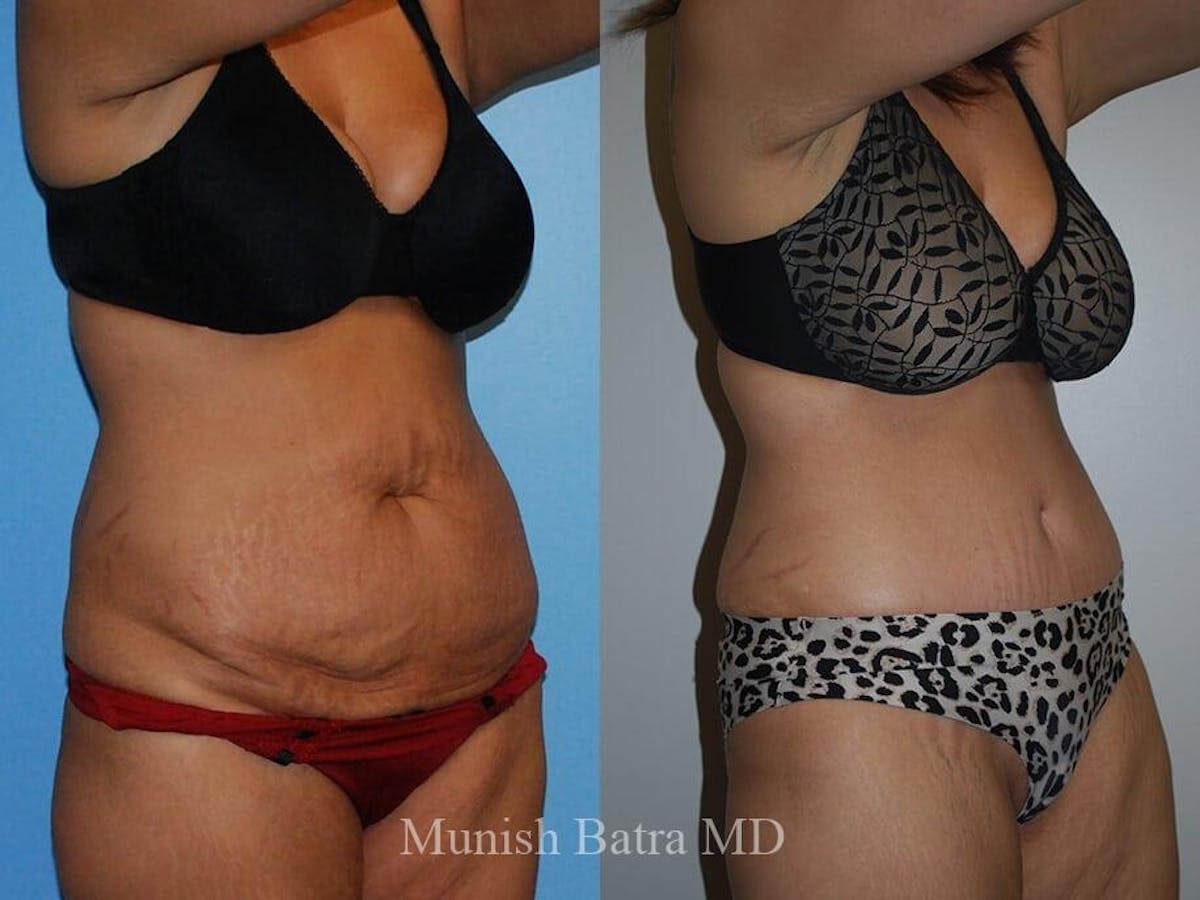 Tummy Tuck Before & After Gallery - Patient 242564 - Image 2