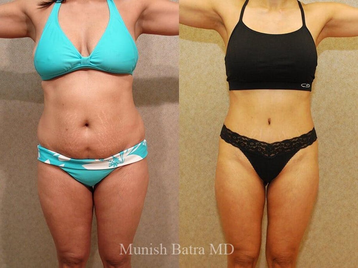 Tummy Tuck Before & After Gallery - Patient 142689 - Image 1