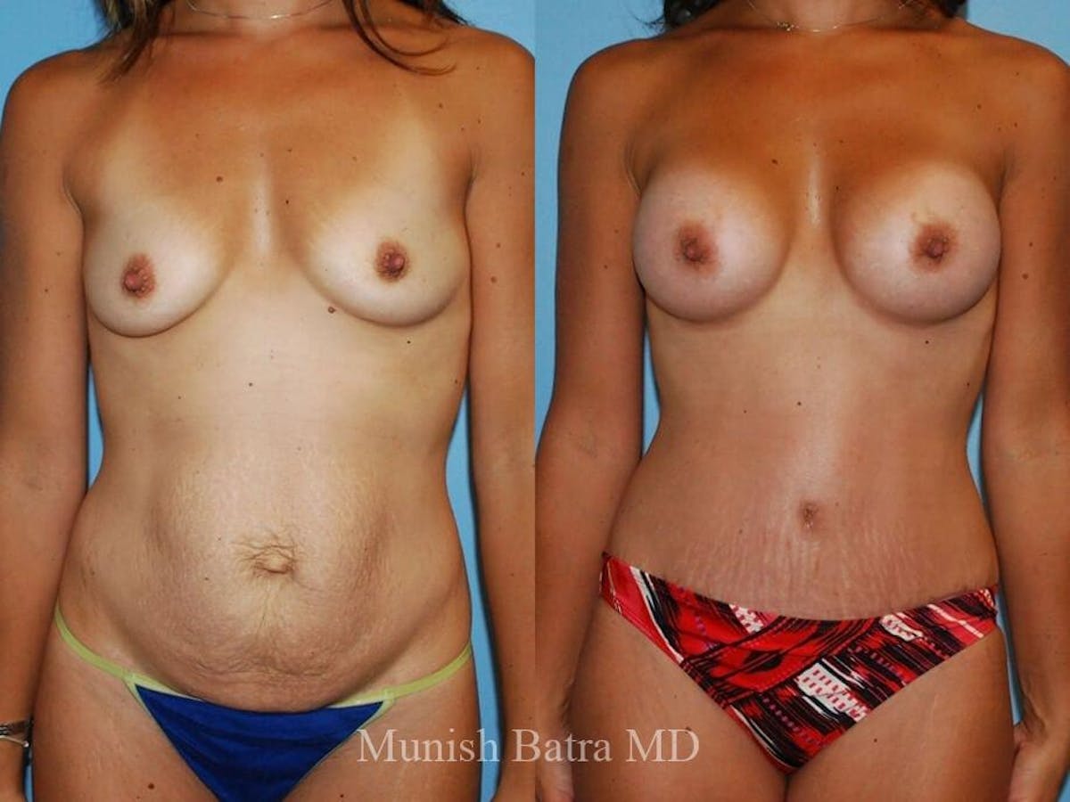 Tummy Tuck Before & After Gallery - Patient 178431 - Image 1