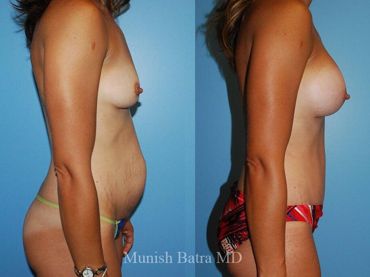 Tummy Tuck Before & After Gallery - Patient 178431 - Image 2