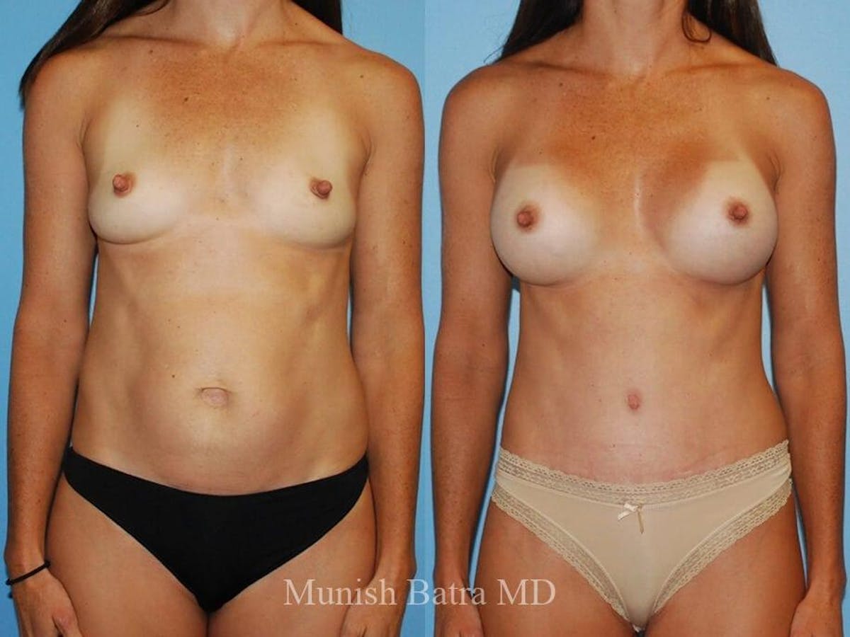 Tummy Tuck Before & After Gallery - Patient 286257 - Image 1