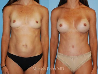 Tummy Tuck Before & After Gallery - Patient 286257 - Image 1