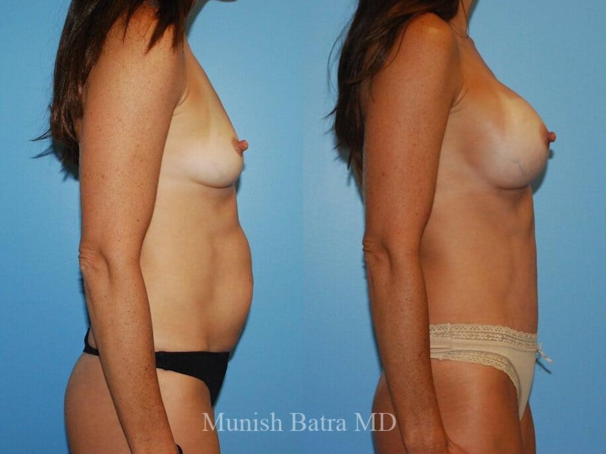 Tummy Tuck Before & After Gallery - Patient 286257 - Image 2