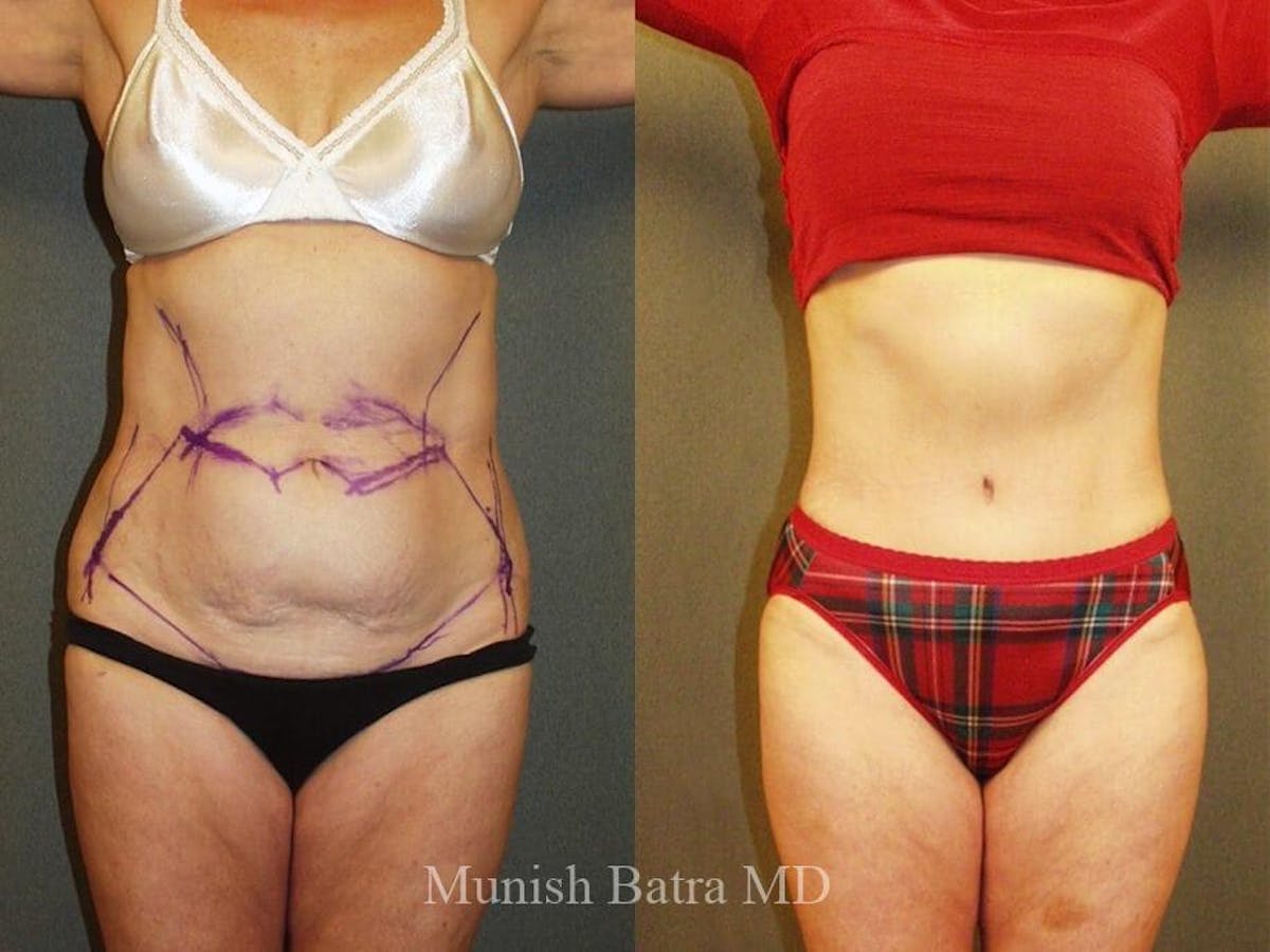 Tummy Tuck Before & After Gallery - Patient 308899 - Image 1