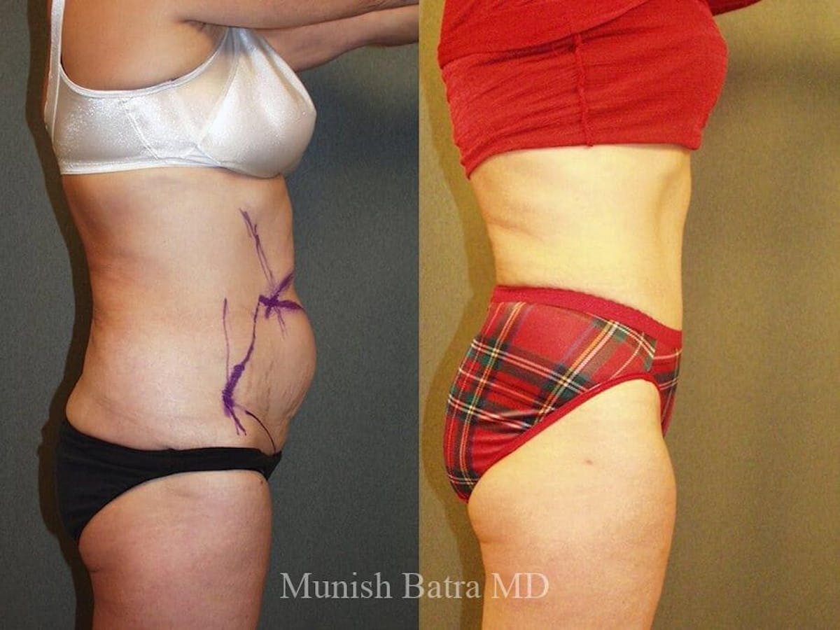 Tummy Tuck Before & After Gallery - Patient 308899 - Image 2