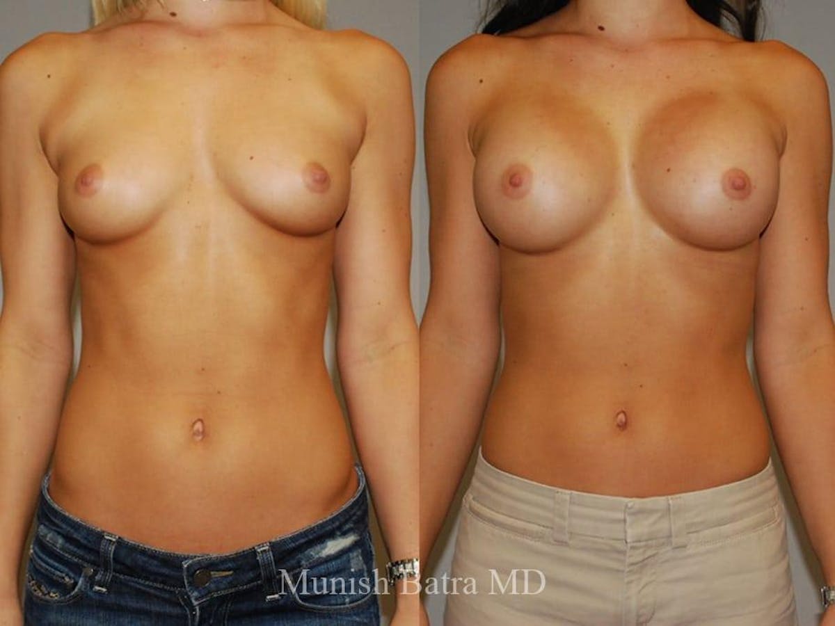 Breast Augmentation Before & After Gallery - Patient 104249 - Image 1