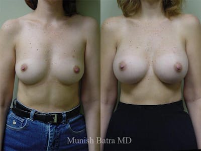 Breast Augmentation Before & After Gallery - Patient 416771 - Image 1