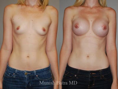 Breast Augmentation Before & After Gallery - Patient 380095 - Image 1
