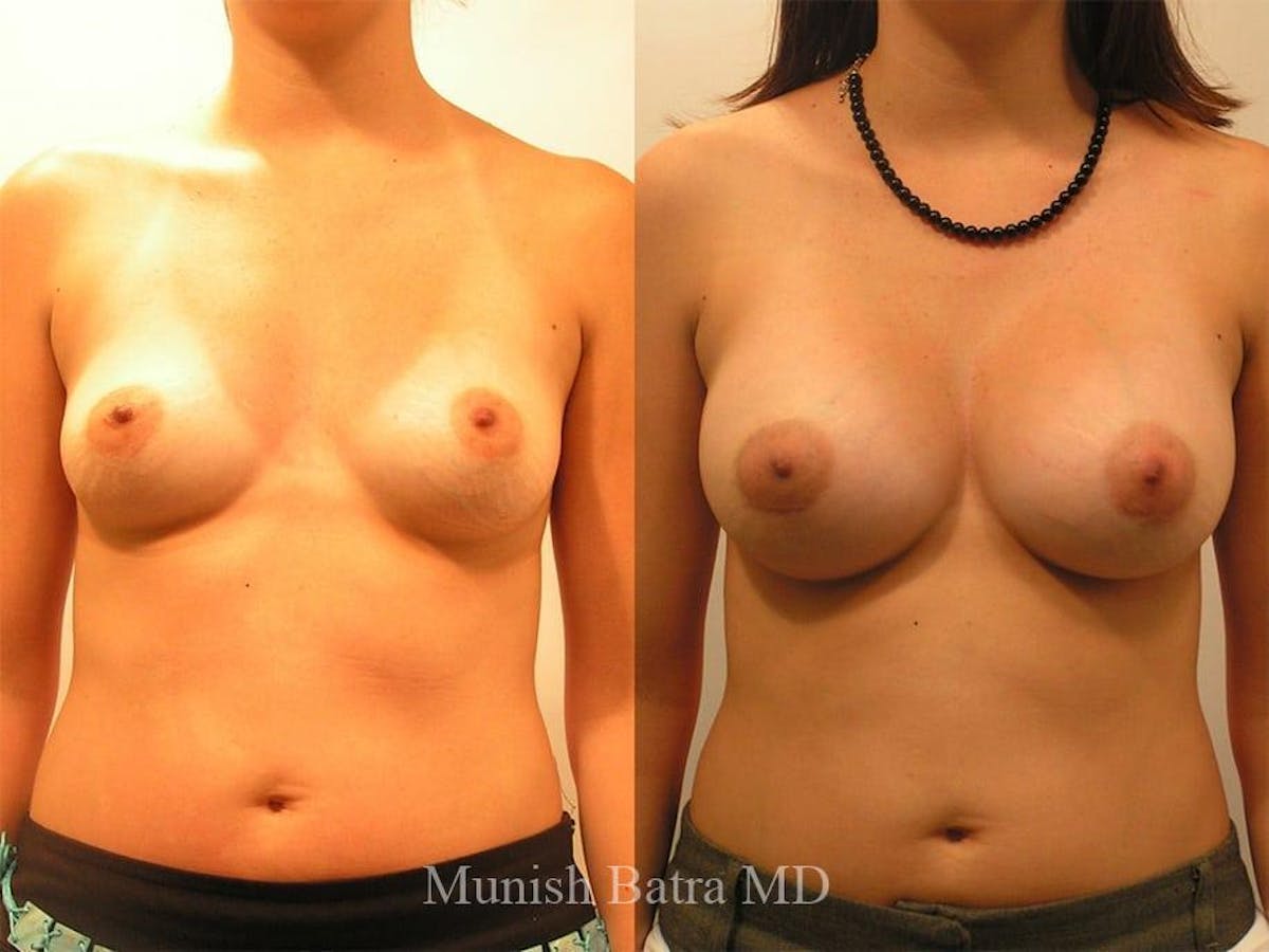 Breast Augmentation Before & After Gallery - Patient 447920 - Image 1