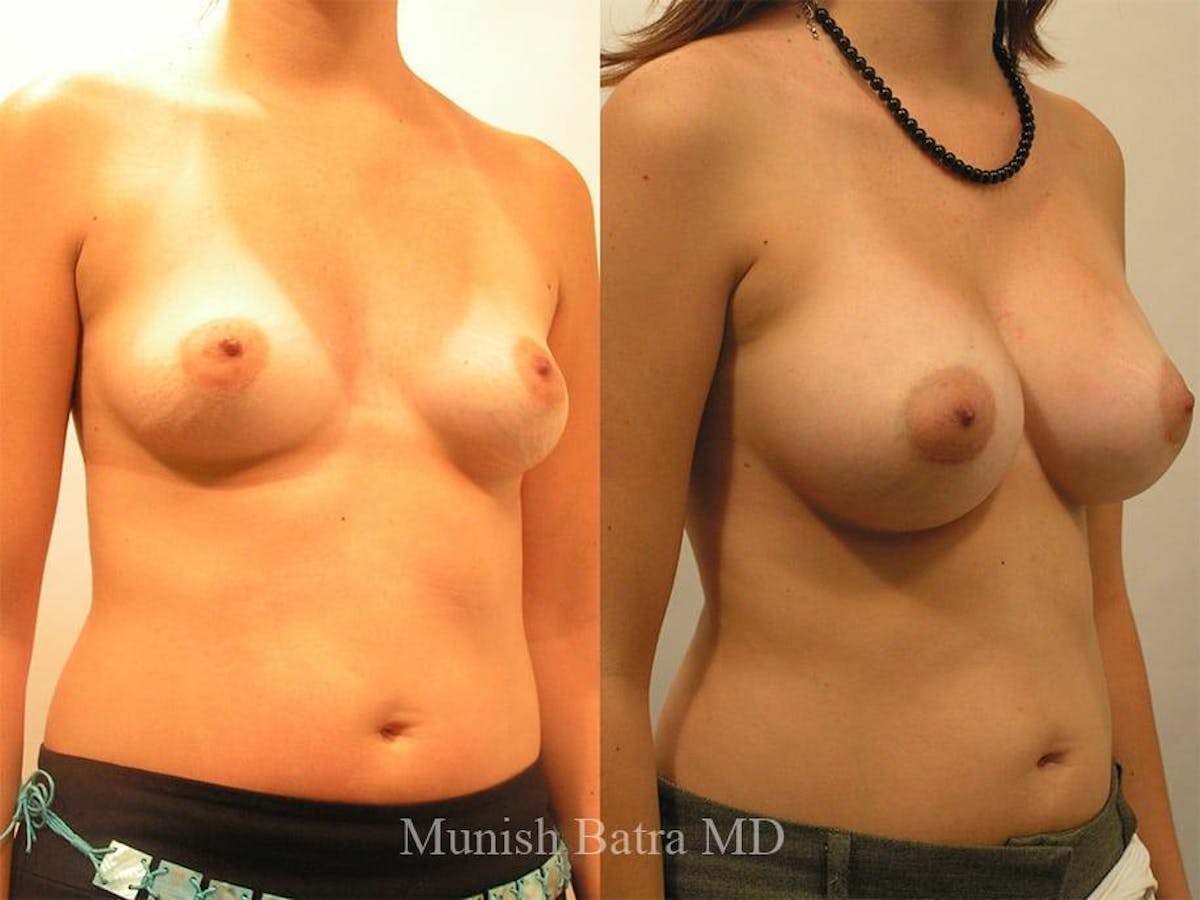Breast Augmentation Before & After Gallery - Patient 447920 - Image 2