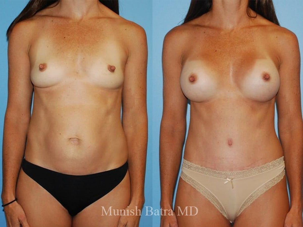 Breast Augmentation Before & After Gallery - Patient 214872 - Image 1
