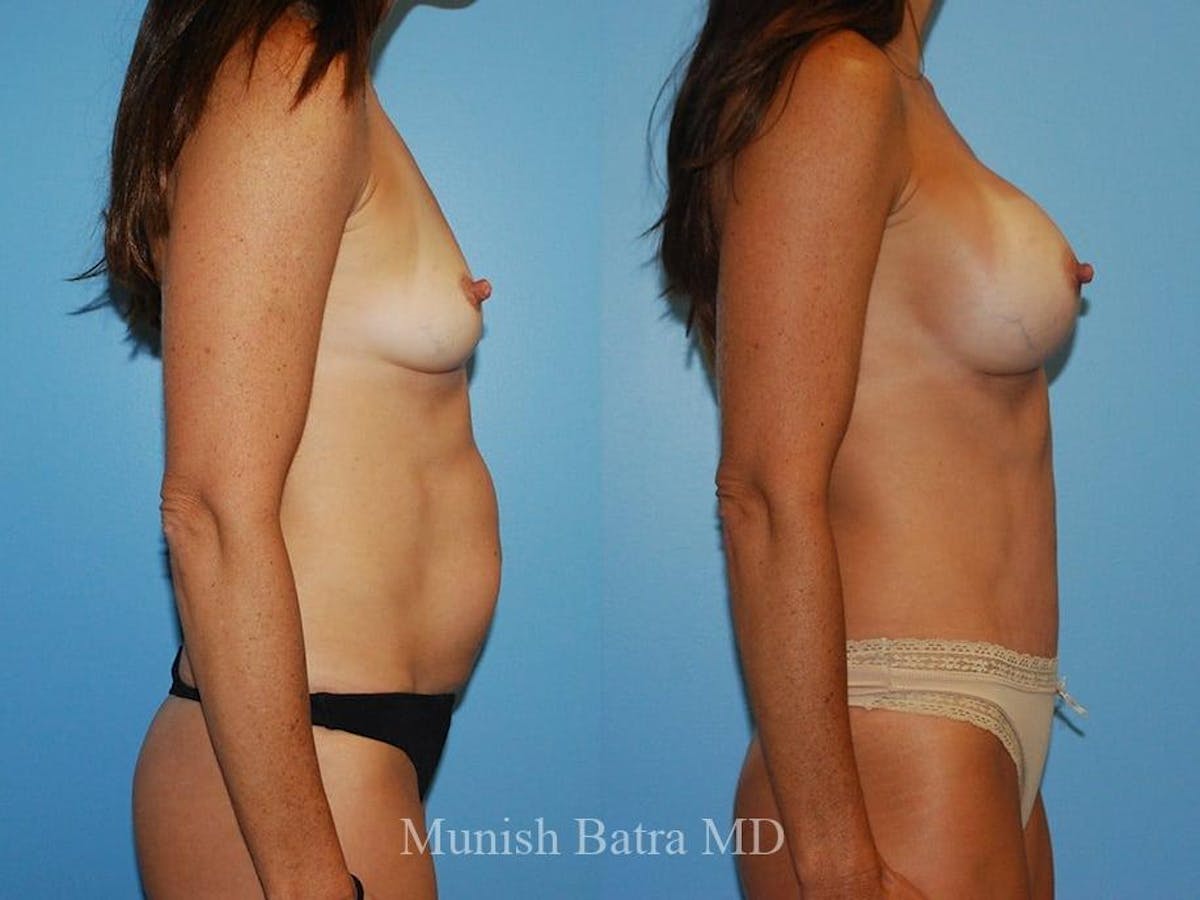 Breast Augmentation Before & After Gallery - Patient 214872 - Image 2