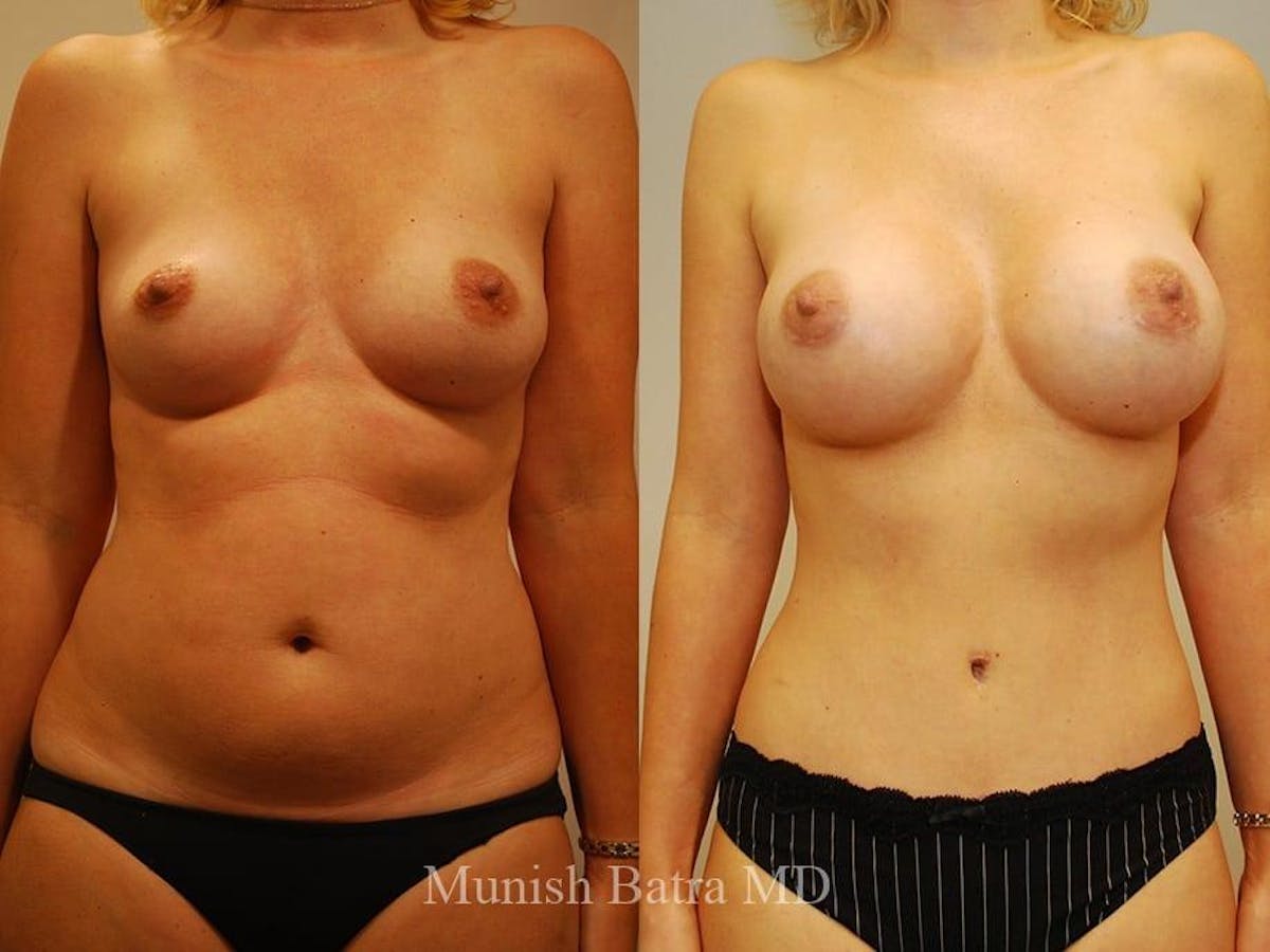 Breast Augmentation Before & After Gallery - Patient 951572 - Image 1