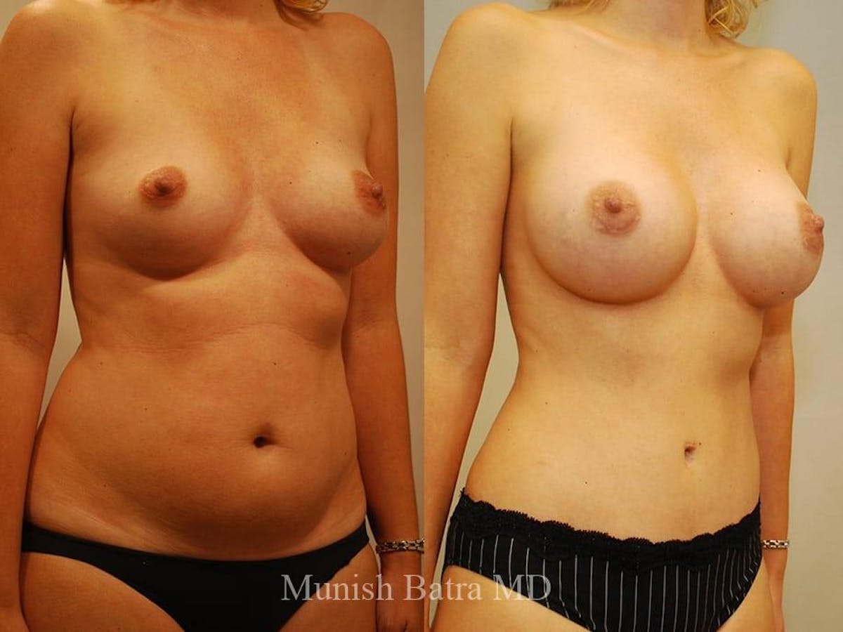 Breast Augmentation Before & After Gallery - Patient 951572 - Image 2
