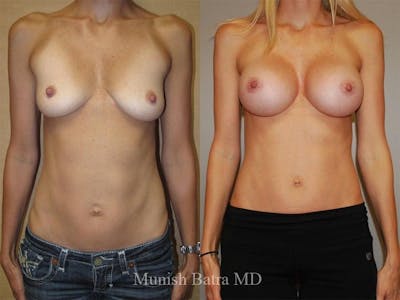 Breast Augmentation Before & After Gallery - Patient 290972 - Image 1