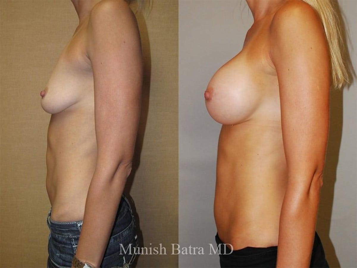 Breast Augmentation Before & After Gallery - Patient 290972 - Image 2
