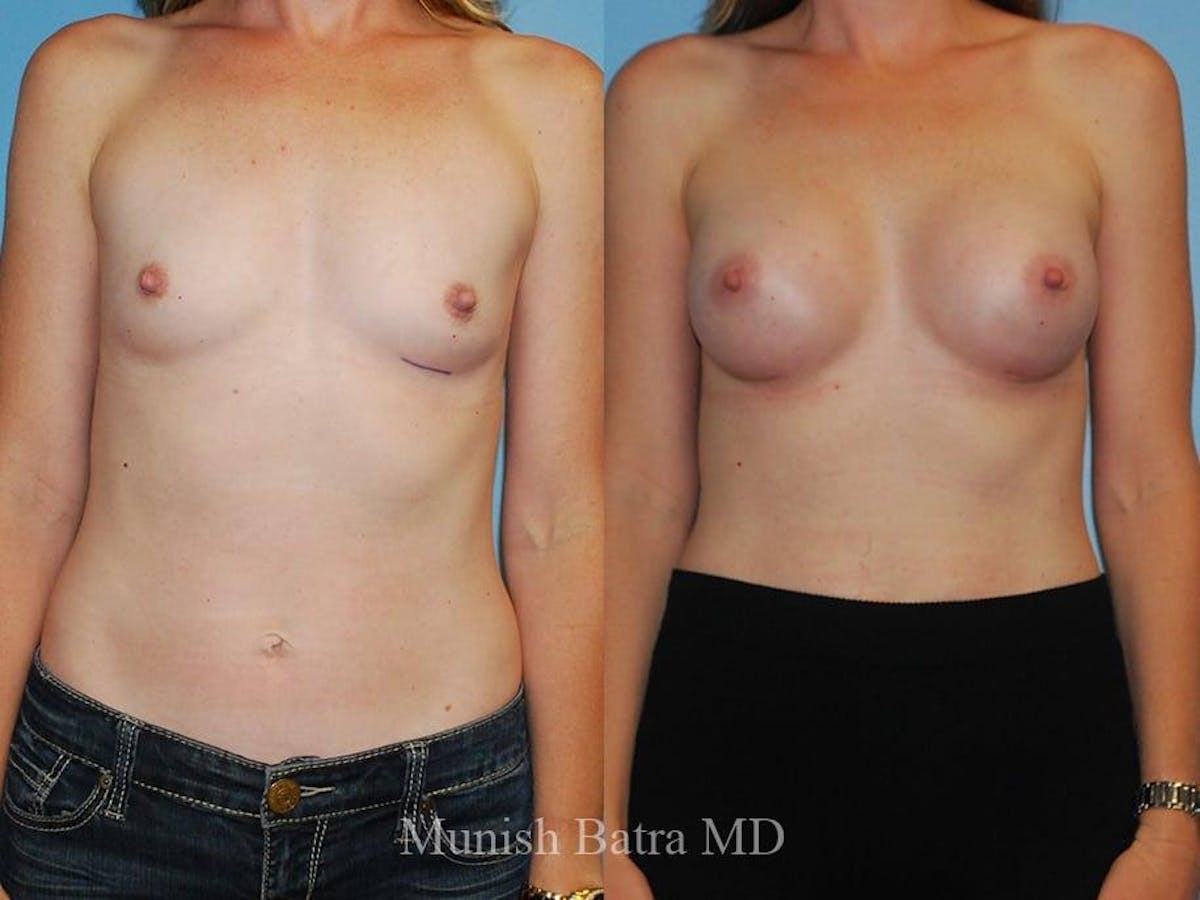 Breast Augmentation Before & After Gallery - Patient 183498 - Image 1