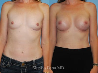 Breast Augmentation Before & After Gallery - Patient 183498 - Image 1