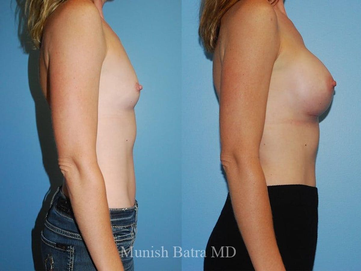 Breast Augmentation Before & After Gallery - Patient 183498 - Image 2