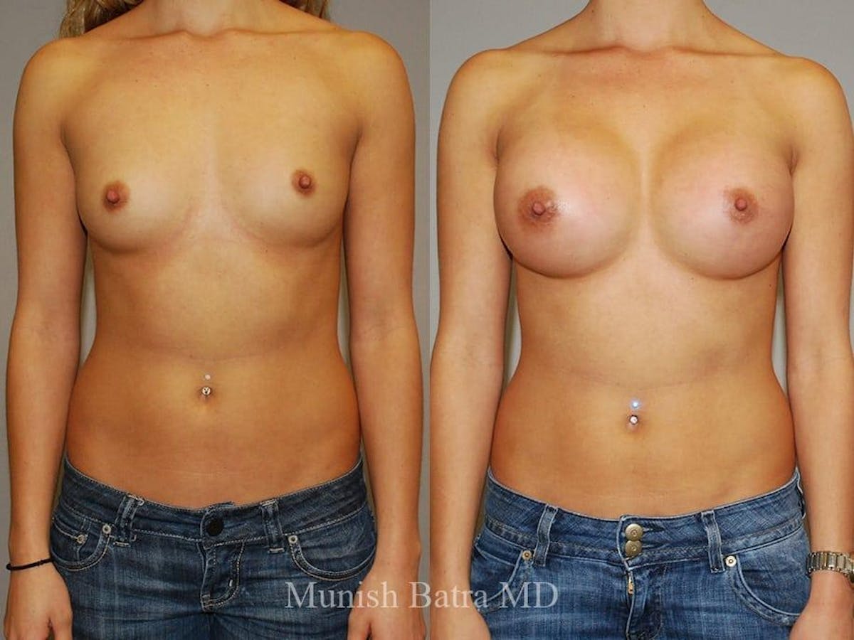 Breast Augmentation Before & After Gallery - Patient 153422 - Image 1