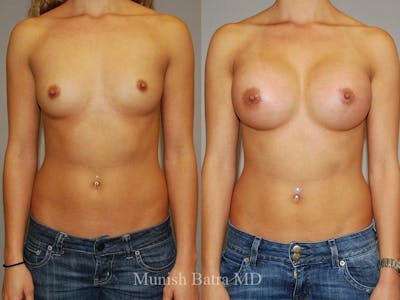 Breast Augmentation Before & After Gallery - Patient 153422 - Image 1