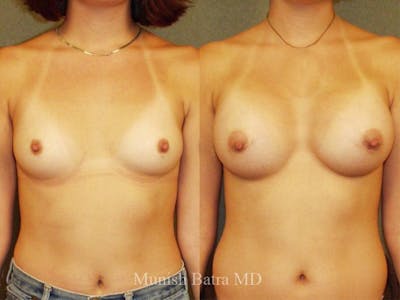 Breast Augmentation Before & After Gallery - Patient 361687 - Image 1