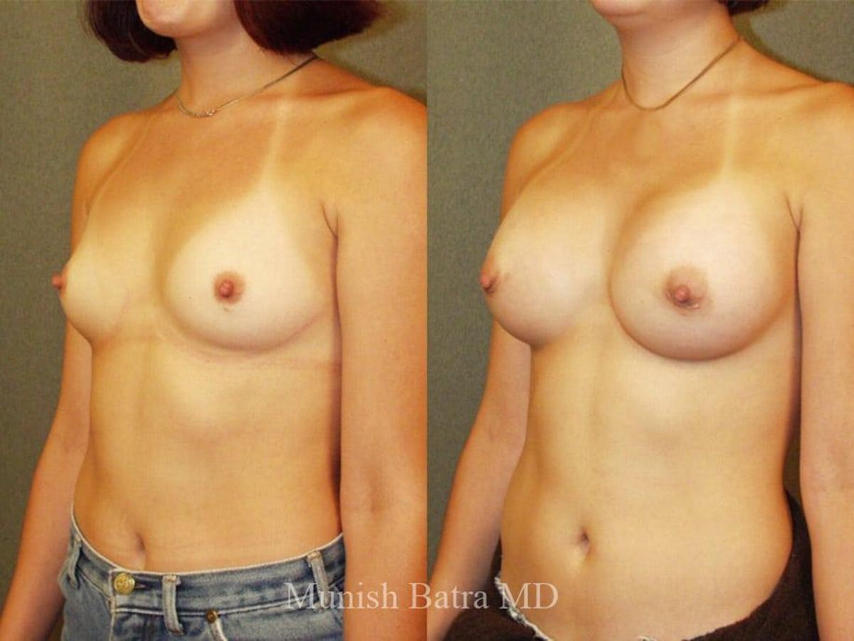 Breast Augmentation Before & After Gallery - Patient 361687 - Image 2