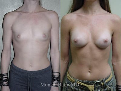 Breast Augmentation Before & After Gallery - Patient 273214 - Image 1