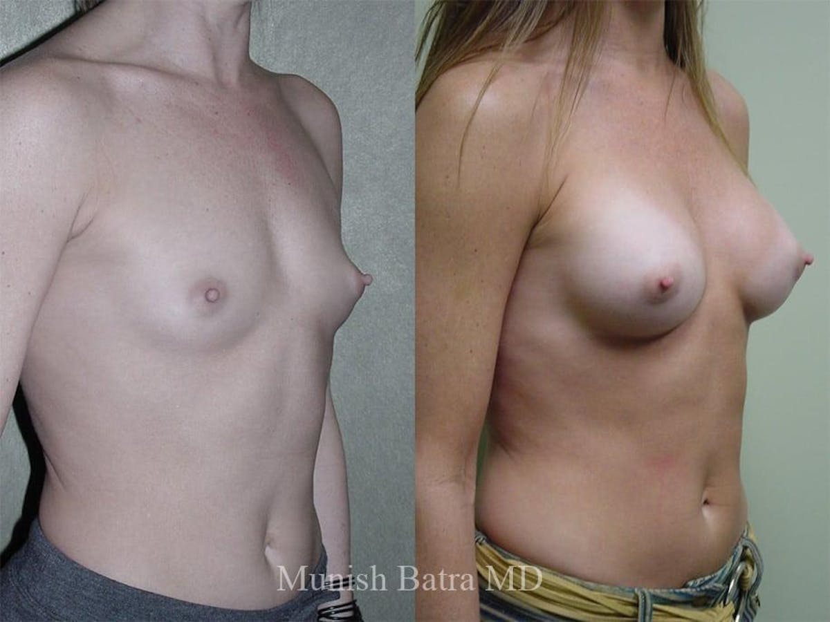Breast Augmentation Before & After Gallery - Patient 273214 - Image 2