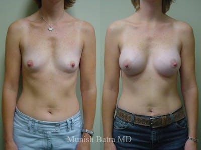 Breast Augmentation Before & After Gallery - Patient 162379 - Image 1