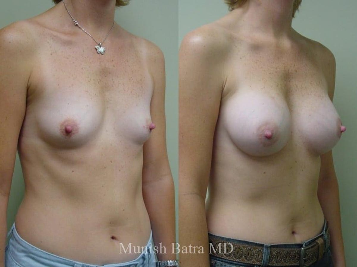 Breast Augmentation Before & After Gallery - Patient 162379 - Image 2