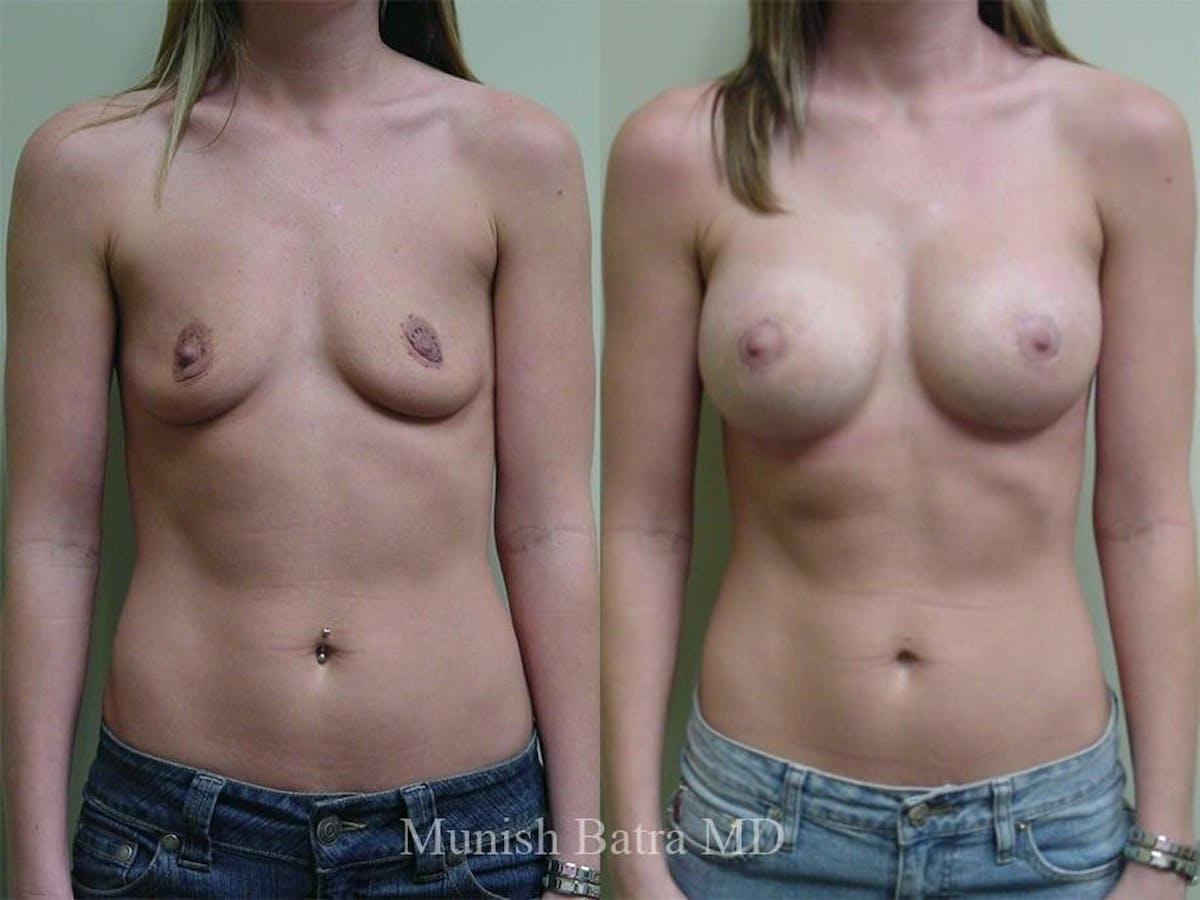 Breast Augmentation Before & After Gallery - Patient 275903 - Image 1